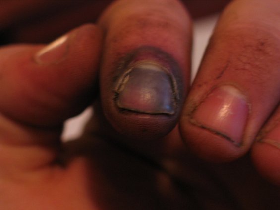 smashed-finger-1.jpg 