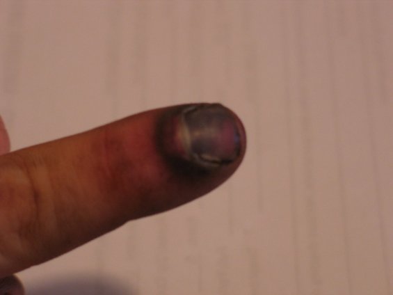 smashed-finger-2.jpg 