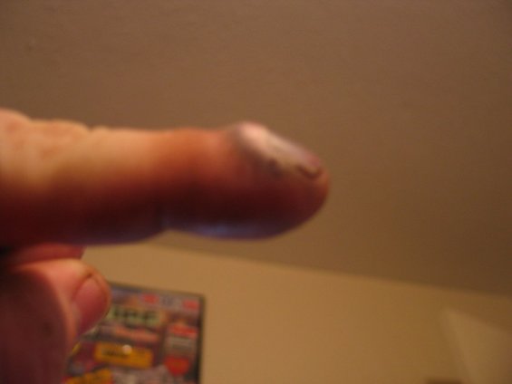 smashed-finger-3.jpg 